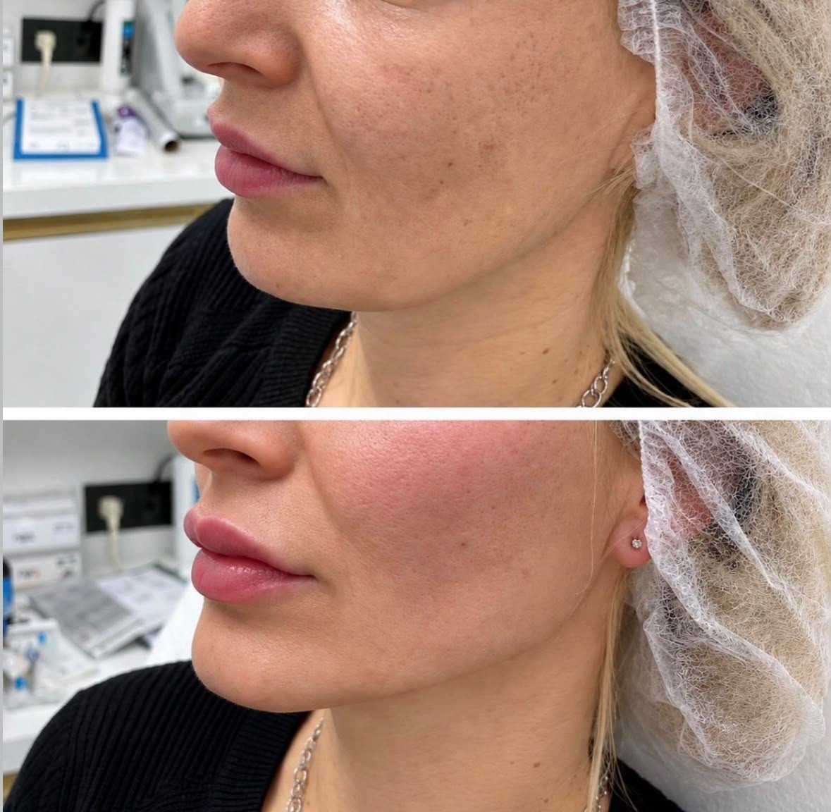 Harmonização Facial