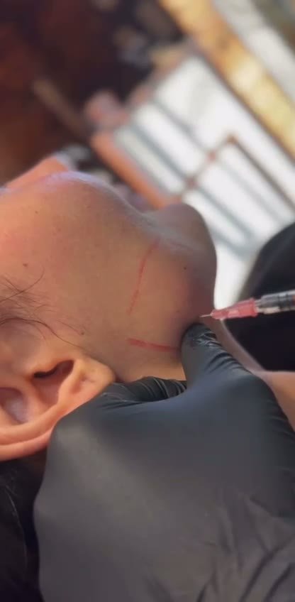 Botox em Apucarana